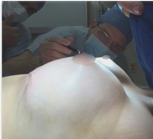 Breast Augmentation (Photo: JE Lixa)