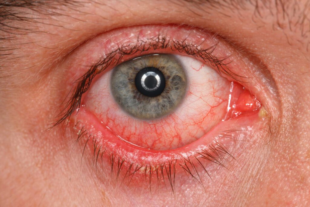 New Covid subvariant symptom alert: hemorrhagic conjunctivitis - The ...